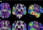 Experimental Alzheimer's drug shows some promise as researchers hunt new approaches