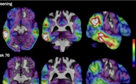 Experimental Alzheimer's drug shows some promise as researchers hunt new approaches