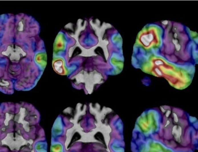 Experimental Alzheimer's drug shows some promise as researchers hunt new approaches