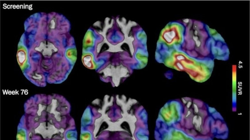 Experimental Alzheimer's drug shows some promise as researchers hunt new approaches